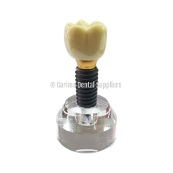 Unique Dental - Tooth Model Implant