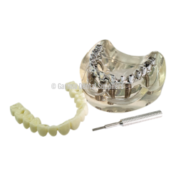 Unique Dental - Tooth Model Screw Implant