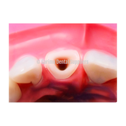 Root Canal #11