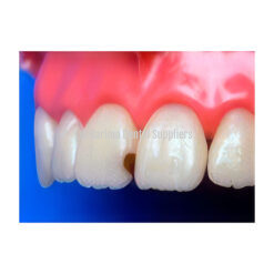 Tooth Decay Mesial #11