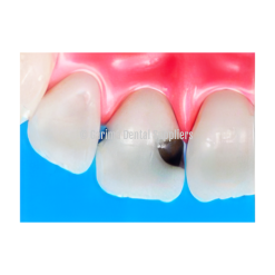 Tooth Decay Mesial / Distal #21